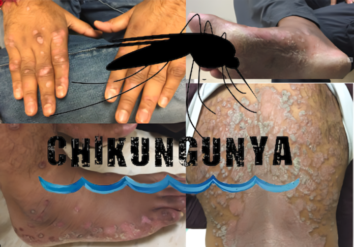 Chikungunya Virus Infection Symptoms and NIH Public Safety Guidelines