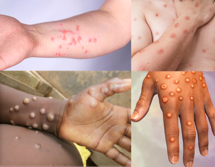 Monkeypox Virus Infected Patients