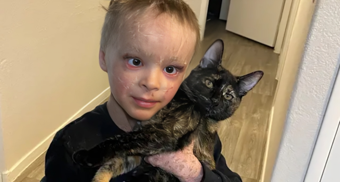 Boy with Rare Skin Condition Receives Life-Changing Treatment After 7 Years