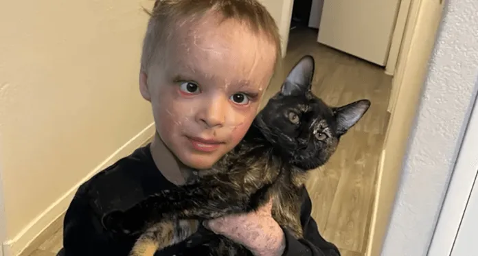 Boy with Rare Skin Condition Receives Life-Changing Treatment After 7 Years